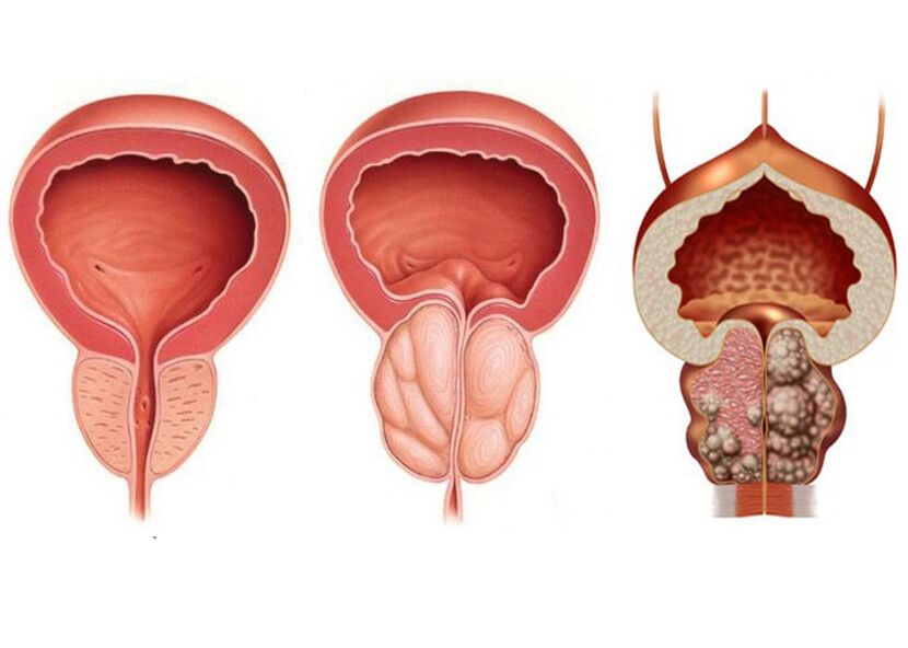 Prostatitisstadien und die Notwendigkeit, Prostavit vollständig zu verwenden