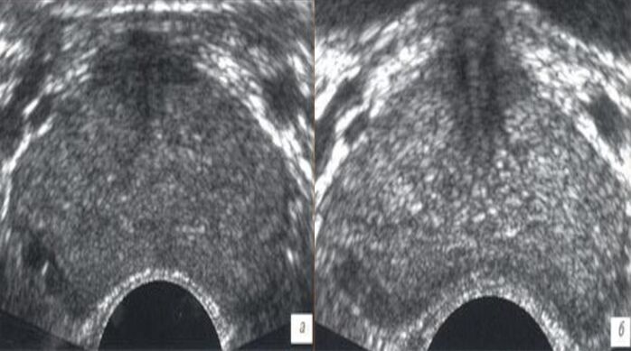 Ultraschall vor und nach der Behandlung mit Tropfen Prostovit