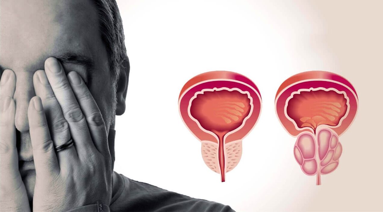 Gesunde und schmerzende Prostata bei Männern
